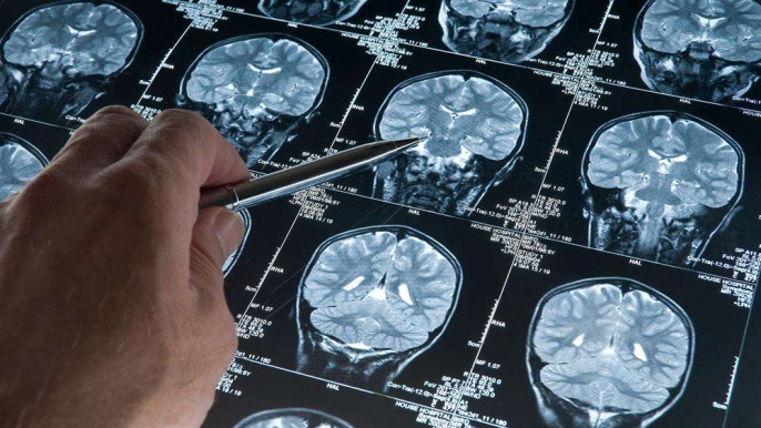 Şok eden araştırma: Alzheimer, belirtiler başlamadan yıllar önce sinsi sinsi ilerliyor! 1