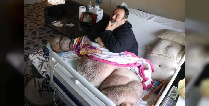 5 yıldır evden çıkamayan fil hastası fil adamın yürek burkan hayali: Eşiyle kol kola caddede yürümek