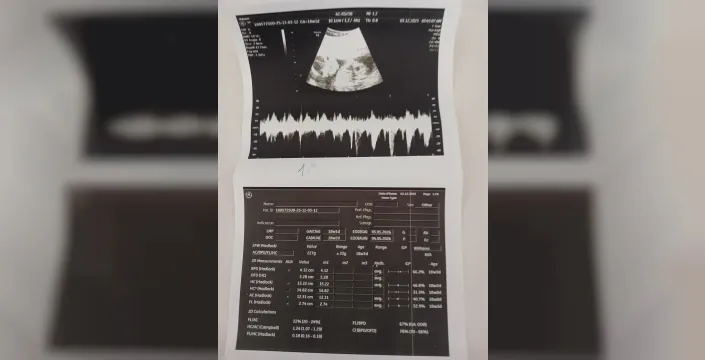Mucize ameliyat: 5.5 aylık hamile kadının beyninden 7 cm'lik tümör alındı